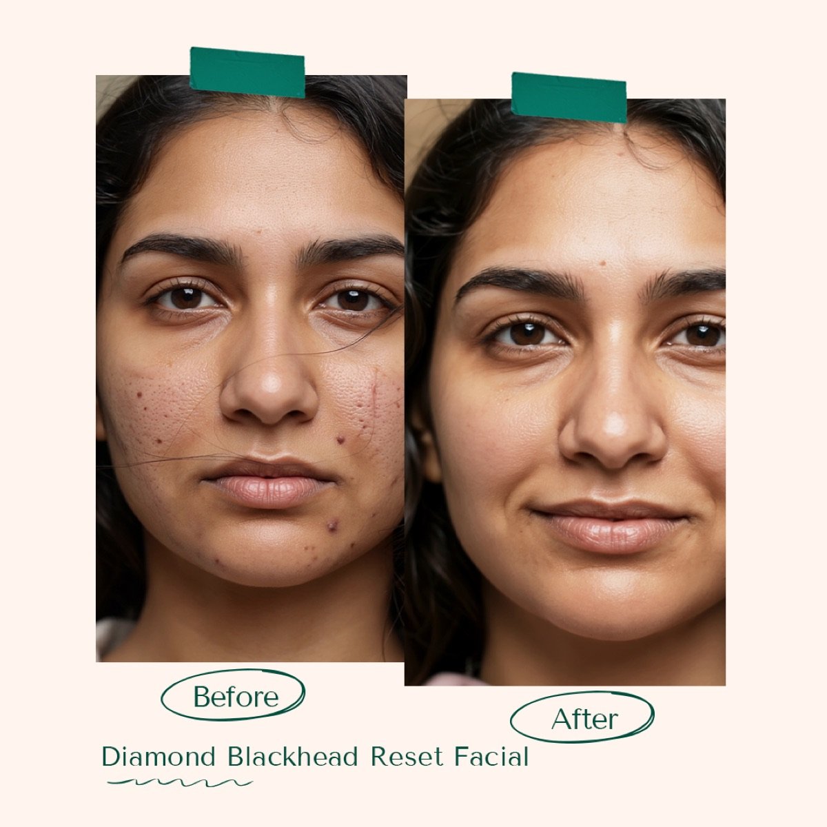 Diamond Blackhead Reset Facial
