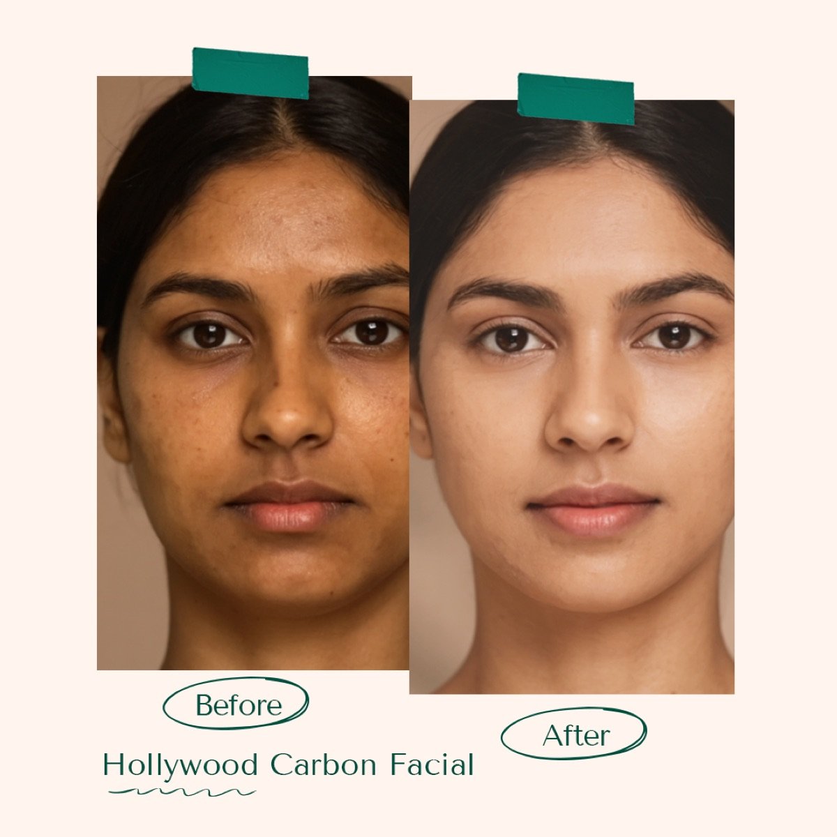 Hollywood Carbon Facial