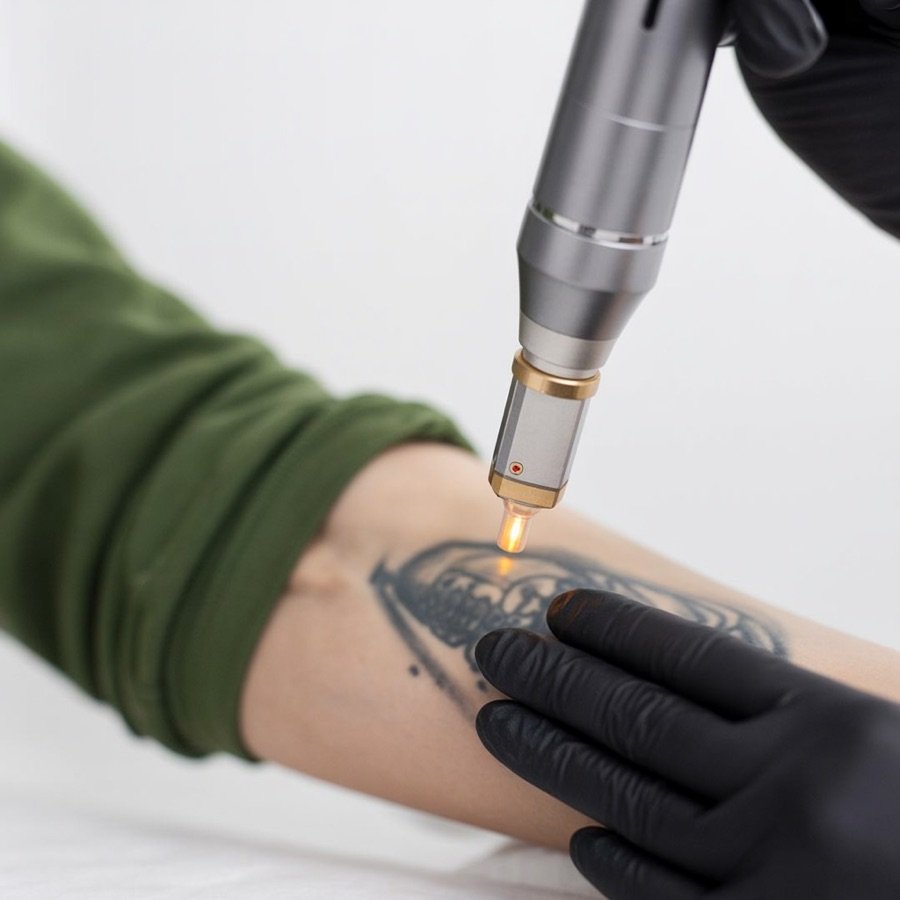 Tattoo Removal