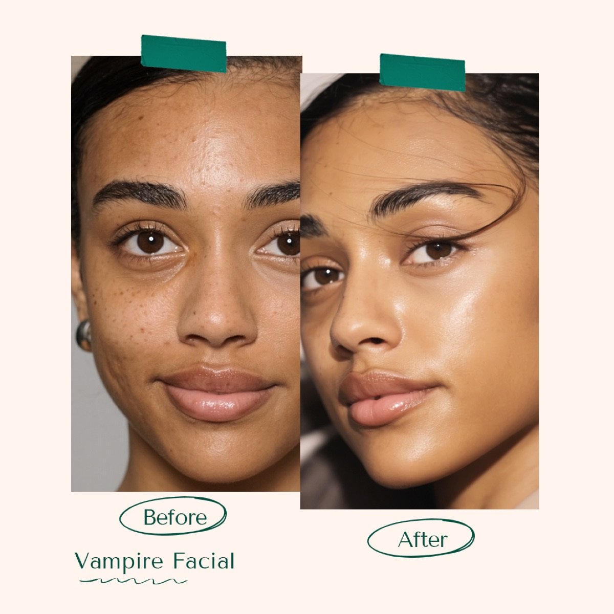 Vampire Facial